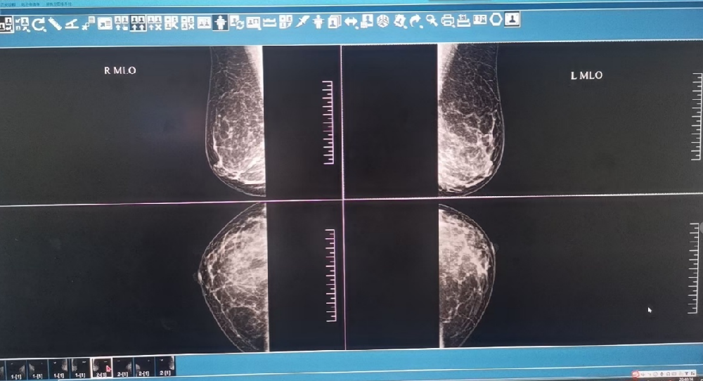 女性乳腺钼靶检查全攻略：作用、优势、注意事项与结果解读误区