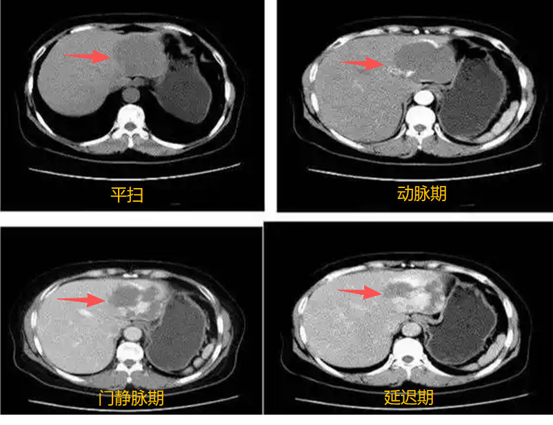 “不知如何是好？”影像科检查：CT、MRI、平扫、增强一次看懂